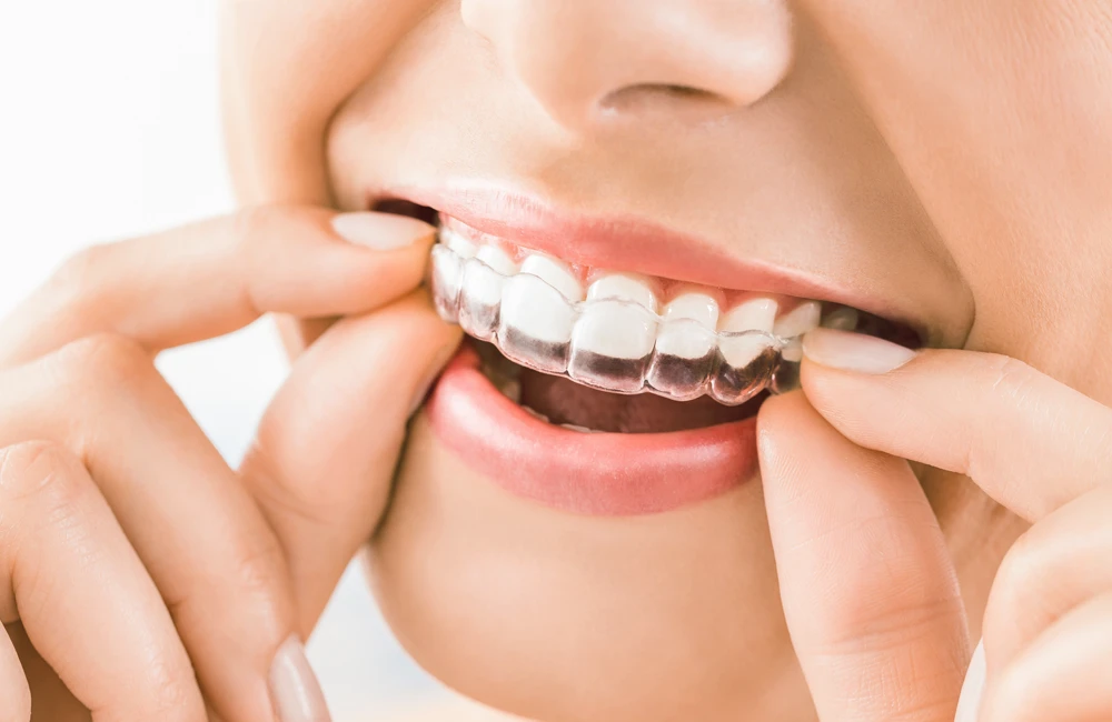 Aligner-Therapie mit Spark 